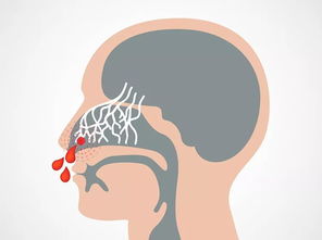 如何应对流鼻血情况：有效止血方法分享,如何应对流鼻血情况：有效止血方法分享,第1张