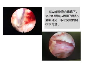 运动与预防：如何避免腰间盘突出问题？,运动与预防：如何避免腰间盘突出问题？,第1张